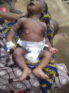 mpox nei bambini mpox nei bambini